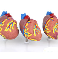 Modelo corazon comparativo sano y enfermo con infarto microcardio vs insuficiencia cardiaca