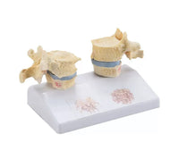 Modelo de osteoporosis de la columna vertebral humana - Alta Simulacion