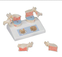 Modelo de osteoporosis de la columna vertebral humana - Alta Simulacion