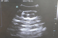 Simulador ultrasonido guiado punsion renal - biopsia
