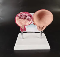 Modelo de comparación entre la vejiga de fumar y normal urologia