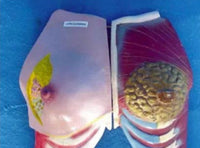 Anatomía pecho comparativo de mujer patología vs saludable.