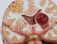 Modelo Cerebral Senil con patología