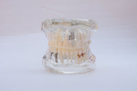 Modelo de implantes dentales