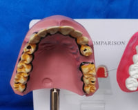 Dientes médicos patológicos. (fumador)