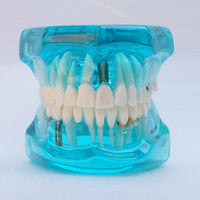 Modelo de implantes dentales