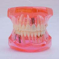Modelo de implantes dentales