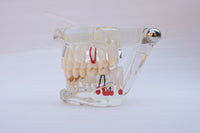 Modelo de implantes dentales