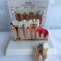 Modelo Anatomico Dental- Patología.