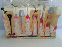 Modelo Anatomico Dental- Patología.