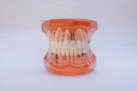 Modelo de implantes dentales
