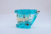 Modelo de implantes dentales
