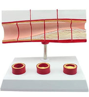 Modelo anatomico de colesterol en sangre arterias ateroesclerosis