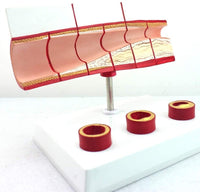 Modelo anatomico de colesterol en sangre arterias ateroesclerosis