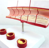 Modelo anatomico de colesterol en sangre arterias ateroesclerosis