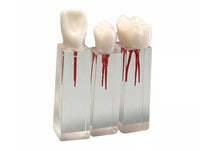 Modelo dental de restauracion bloqueo endodoncia 6 piezas