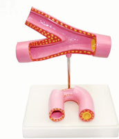 Modelo de arteriosclerosis con trombo vaso sanguineo