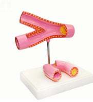 Modelo de arteriosclerosis con trombo vaso sanguineo