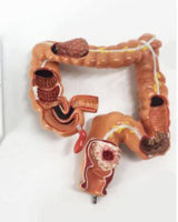 Modelo de Colon y Recto - patologia cancer