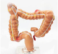 Modelo de Colon y Recto - patologia cancer