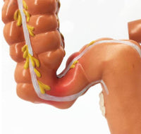 Modelo de Colon y Recto - patologia cancer