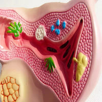Modelo anatómico uterino - Enfermedad Vaginal Enf transmision sexual