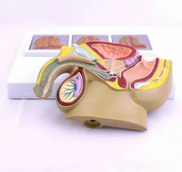 Modelo patológico de Prostata masculino
