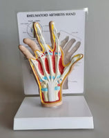 Modelo de Mano artritis reumatoide
