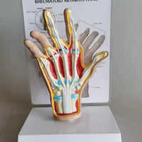 Modelo de Mano artritis reumatoide