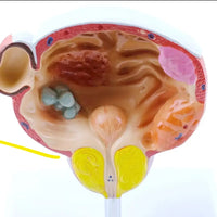 Modelo anatomico enfermedades de vejiga y tumores prostaticos
