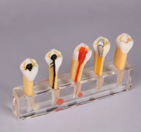 Modelo Dental de 5 etapas para tratamiento endodontico
