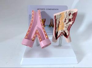 Modelo anatómico Arterias vasculares comparación  aterosclerosis