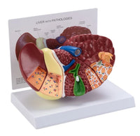 modelo anatomico Higado patologico detallado
