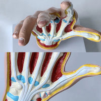 Modelo de Mano artritis reumatoide