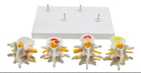 Modelo anatómico degeneracion lumbar vertebras
