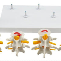 Modelo anatómico degeneracion lumbar vertebras