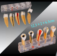 Modelo Dental de 5 etapas para tratamiento endodontico
