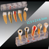 Modelo Dental de 5 etapas para tratamiento endodontico