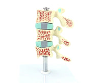 Anatomia osteoporosis intra-vertebral.
