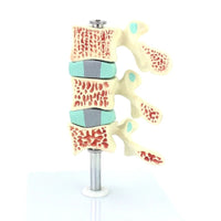 Anatomia osteoporosis intra-vertebral.