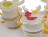 Modelo anatómico degeneracion lumbar vertebras
