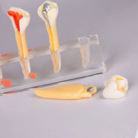 Modelo Dental de 5 etapas para tratamiento endodontico