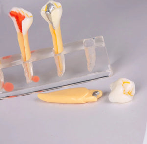 Modelo Dental de 5 etapas para tratamiento endodontico