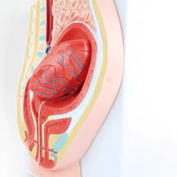 Modelo de desprendimiento separacion de placenta