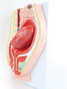 Modelo de desprendimiento separacion de placenta