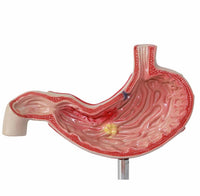 Modelo anatomico de estómago humano con úlcera gástrica
