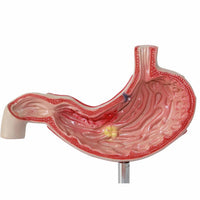 Modelo anatomico de estómago humano con úlcera gástrica