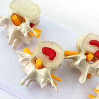 Modelo anatómico degeneracion lumbar vertebras