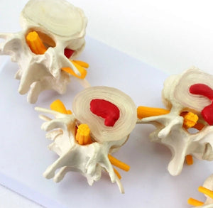 Modelo anatómico degeneracion lumbar vertebras