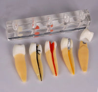 Modelo Dental de 5 etapas para tratamiento endodontico
